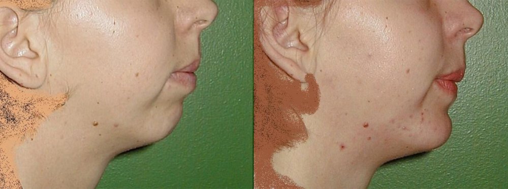 Leicht fliehendes Kinn weibliches Gesicht, indem das Kinn markiert bone 3 Monate nach der Operation stabilizoiván Form voranzutreiben.