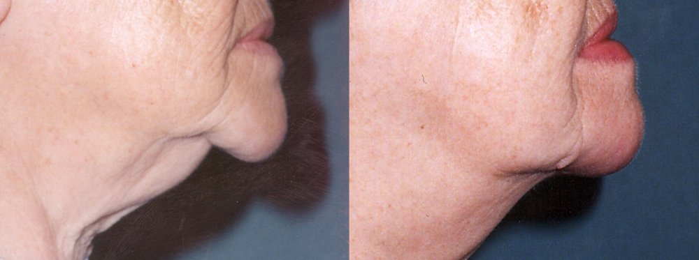 Deutlich lose Haut Kinn und Hals bei älteren Frauen, gute Wirkung nach dem Entfernen der Haut und der Weichgewebe Kinn und Hals Schnitt unter dem Kinn 2 Monate nach der Operation.