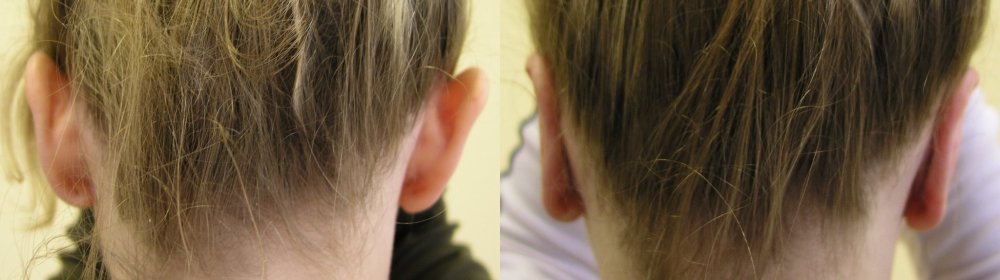 Medium abstehenden Ohren vor und 2 Wochen nach der Operation.