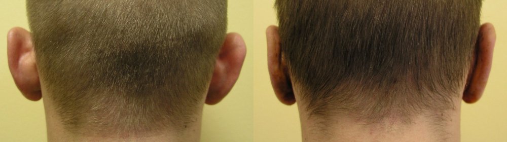 Deutlich abstehenden Ohren vor und 1 Monat nach der Operation.