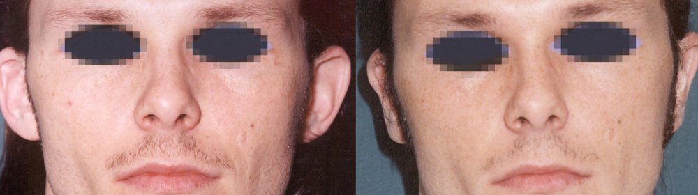 оттопыренные уши - результат трех месяцев после операции.
