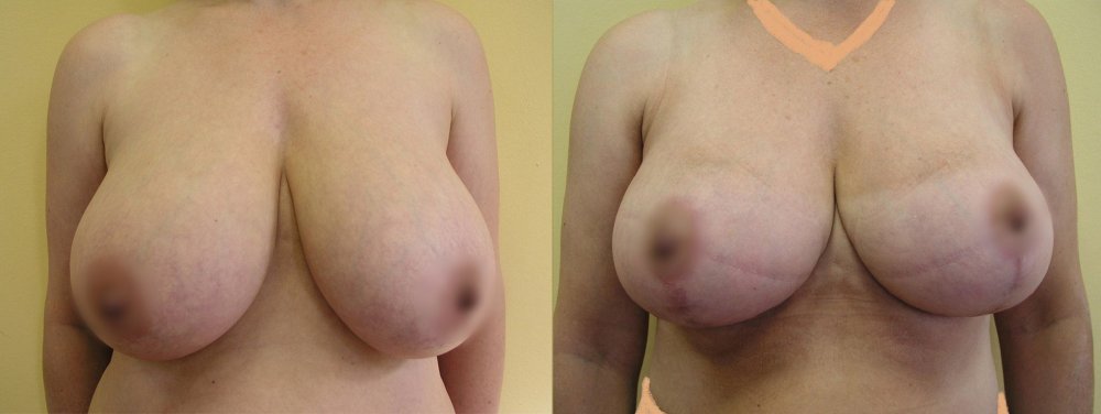 Zpevnění větších prsů s mírnou redukcí velikosti, po 2 týdnech ještě krytí jizev náplasťovými stripy, po 3 měsících tvarově stabilizované, jizvy postupně blednou.
