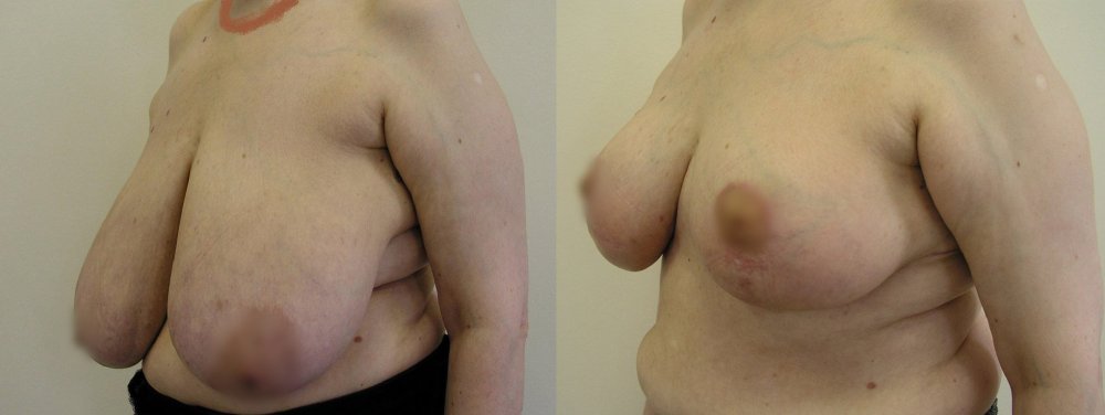 Velké, výrazně povolené prsy s asymetrií, 11 dnů a 3 měsíce po operaci – je vidět postupný tvarový vývoj prsů a přetrvávající mírná asymetrie po stabilizaci tvaru.