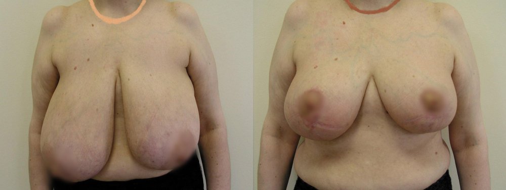 Velké, výrazně povolené prsy s asymetrií, 11 dnů a 3 měsíce po operaci – je vidět postupný tvarový vývoj prsů a přetrvávající mírná asymetrie po stabilizaci tvaru.