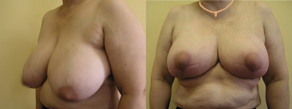 Velké povolené prsy po částečném zmenšení a zpevnění 2 měsíce po operaci, jizvy ještě ne zcela stabilizované.