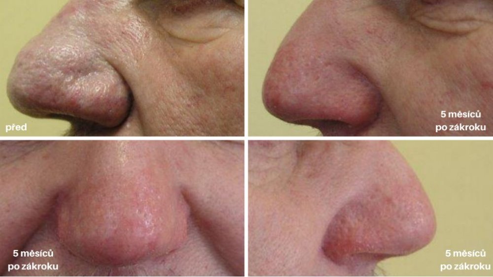 rhinophyma léčba laserem foto před a po