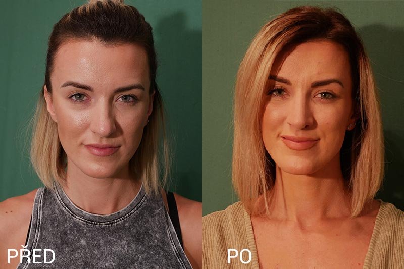 Jak dlouho trvá operace nosní přepážky?
