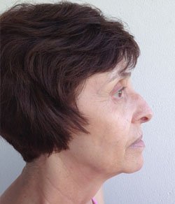 Facelift - necklift 3