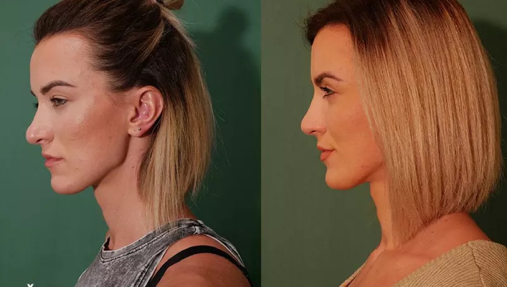 Nose plastic surgery – the story of fitness trainer Kamila