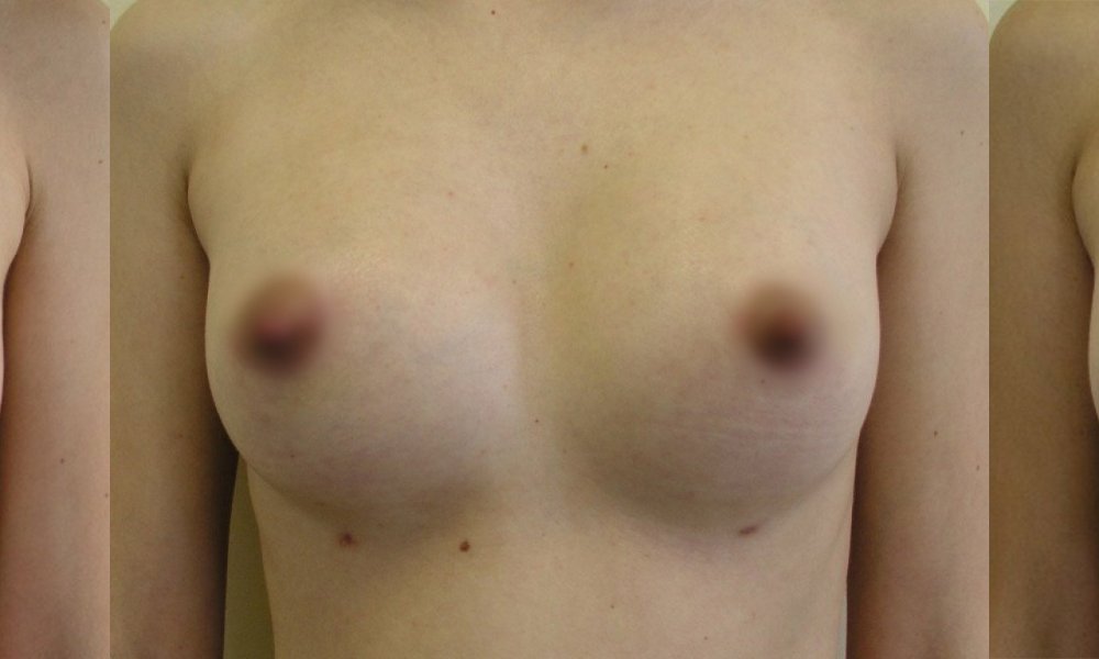 kleine Brüste, mittlerer Vergrößerung, eine Narbe am unteren Rand der Areola, beobachtet die natürliche Form der Evolution 3 Wochen und 6 Monate nach der Operation