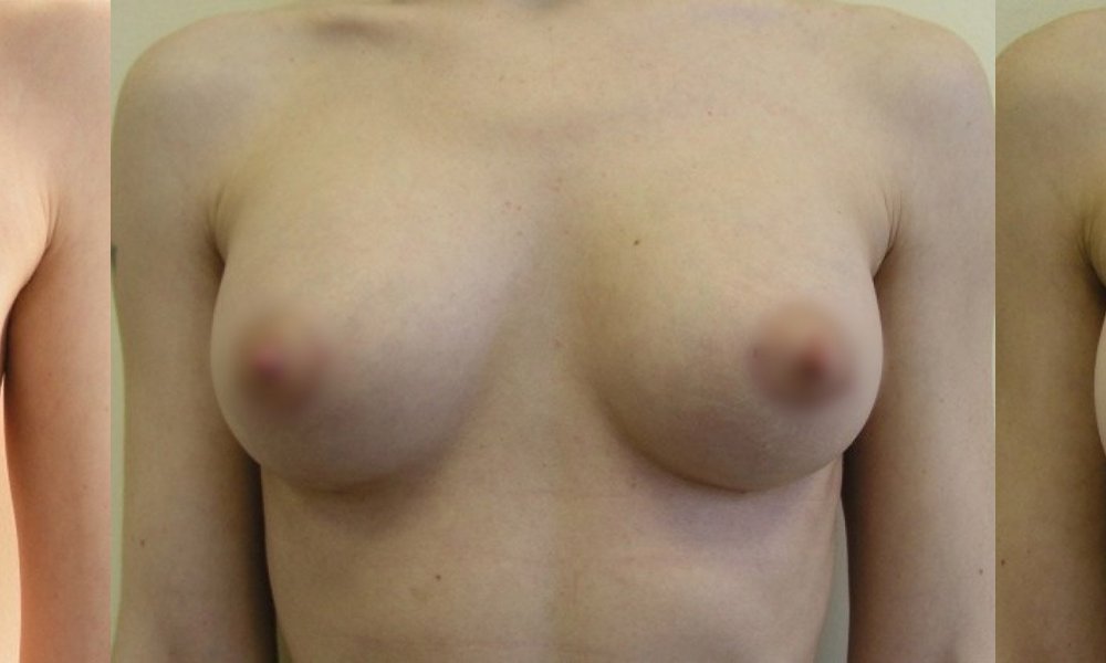 malé prsy, středně velké zvětšení s řezem v dolním oblouku dvorce 1 a 4 měsíce po operaci