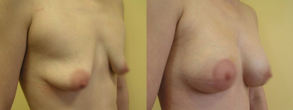 средне слегка свободно груди, скорее дополнять первоначального объема, шрам после 6 недель, чтобы зажить хорошо