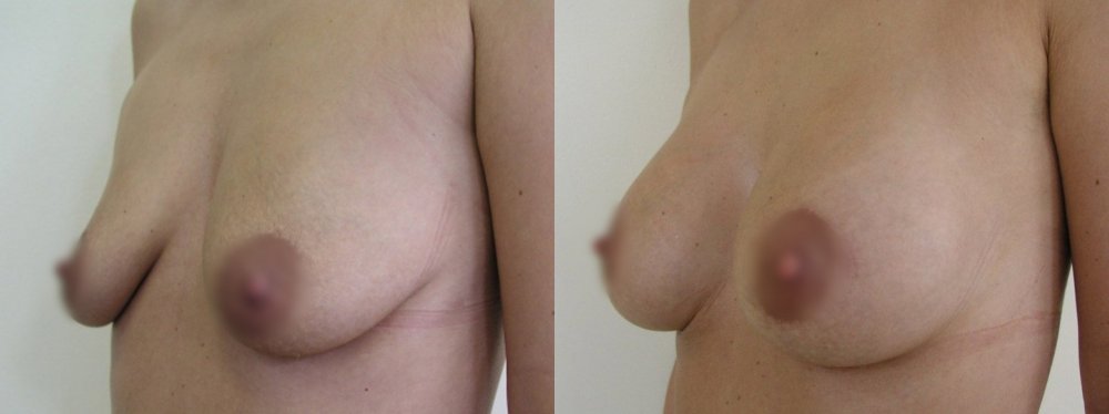 středně velké středně povolené prsy, řezy v horním okraji dvorce s posunem, po 2 a 8 měsících postupná stabilizace jizvy i tvaru prsů