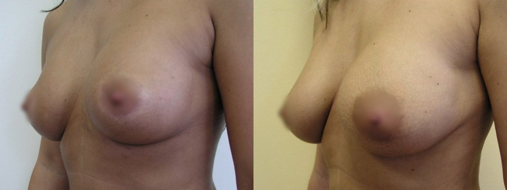 darf etwas kleiner Brüste, im Unterkiefer Warzenhof schneiden kann überwacht die Entwicklung der wohlgeformten Brüste und Narben nach 3 Wochen, 3 und 8 Monate und 1,5 Jahre