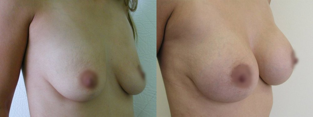 mittelgroße Brüste mit einem leichten Rückgang, im oberen Bereich mit einer leichten Kurve Warzenhof Verschiebung Aussehen und Stabilisierung der Narbe nach 10 Tagen und 5 Wochen nach der Operation
