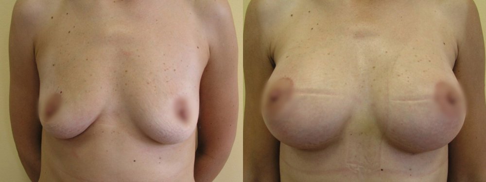 erlaubt geringfügig kleiner Brüste, im Oberkiefer Warzenhof geschnitten, Brust größer Volumenbedarf, Zustand nach 3 Wochen nach der Operation
