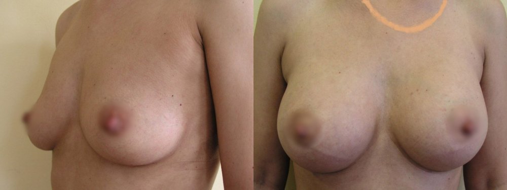 Medium ist erlaubt Brüste leicht mit dem Erfordernis einer Nummer größer Schnitt im unteren Bogen Gerichte, Zustand nach 3 Monaten haben die Narben kaum sichtbar