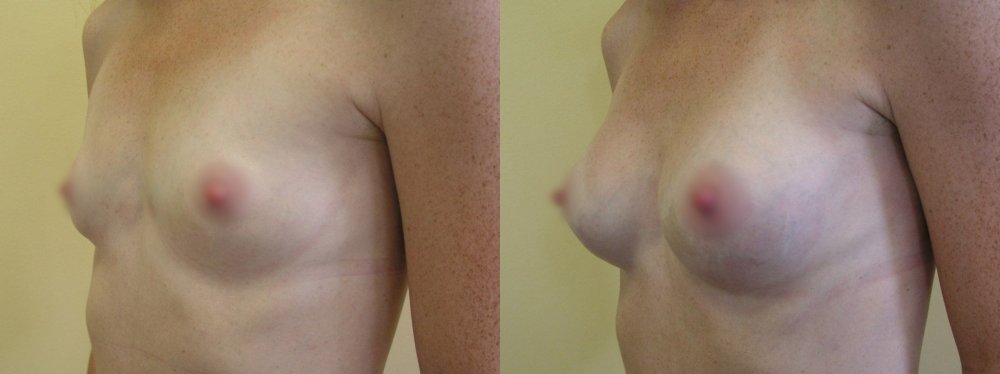 маленькие груди, небольшое увеличение – шрамы на нижнем краю ареолы на 1 и 9 месяцев