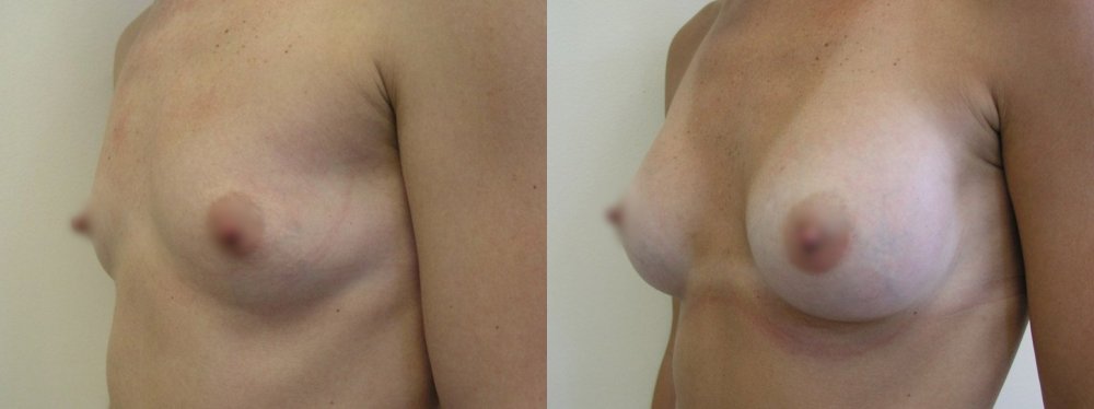маленькая грудь, среднoе увеличение – шрам на нижнем краю ареолы, статус 2 и 8 месяцев