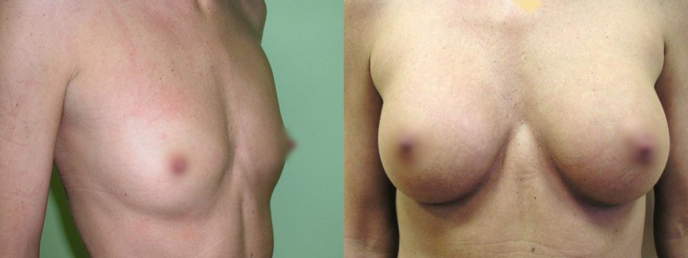маленькая грудь – выраженное расширение, шрам на нижнем краю ареолы, стабильной хорошей форме 3 лет после операции