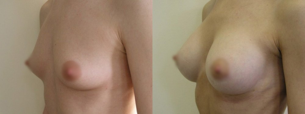 kleine Brüste, mittel Vergrößerung mit einem Einschnitt in den unteren Bogen Gerichten 1 und 4 Monate nach der Operation