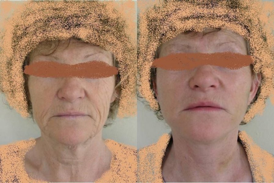 VORHER/NACHHER - Gesicht mit schlaffe Haut im unteren Teil und Hals – nach 11 Tagen keine Wirkung spürbar Falten auf der Oberlippe sollte Laserchirurgie des Gesichts gelöst hier nicht bewirken
