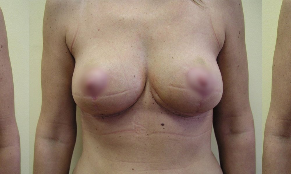 Erlaubt kleineren Brüsten 1 und 4 Monate nach straffende und modellierende Drüsen allmählich verblassenden Narben. 