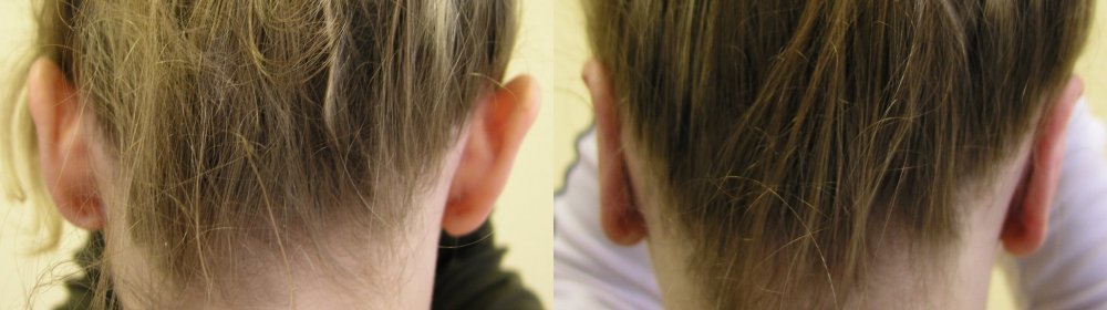 Средний оттопыренные уши до и 2 недели после операции.