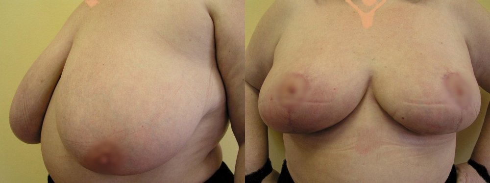 Velké dosti povolené prsy, zmenšení a modelace žlázy 6 týdnů po operaci.