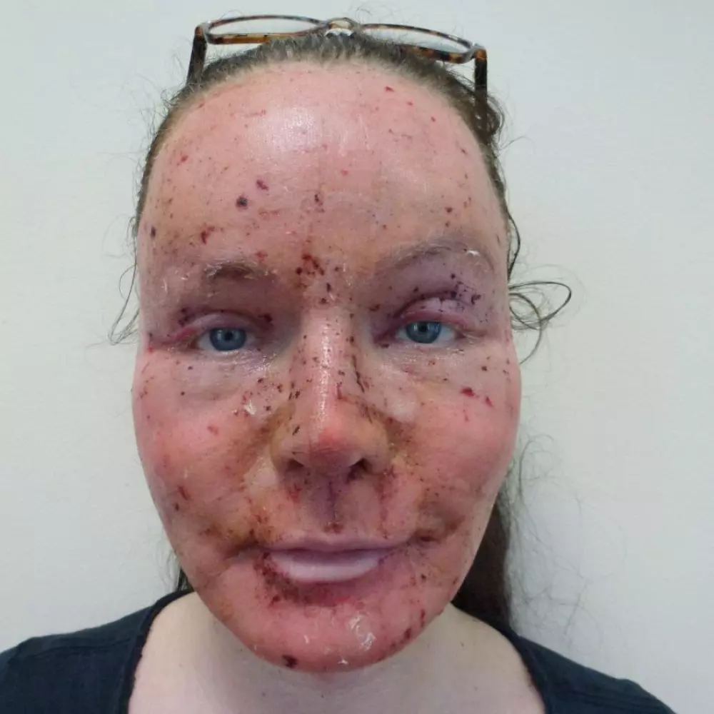 1st day after surgery
