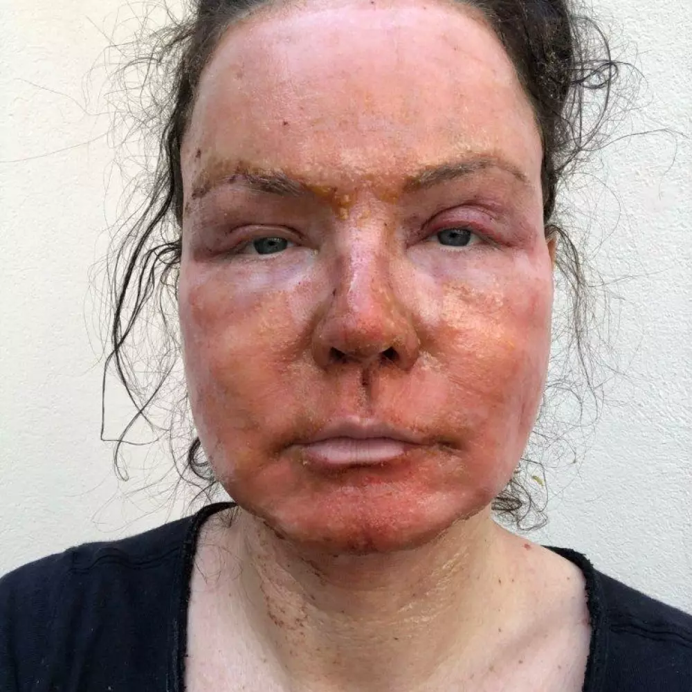 2nd day after surgery
