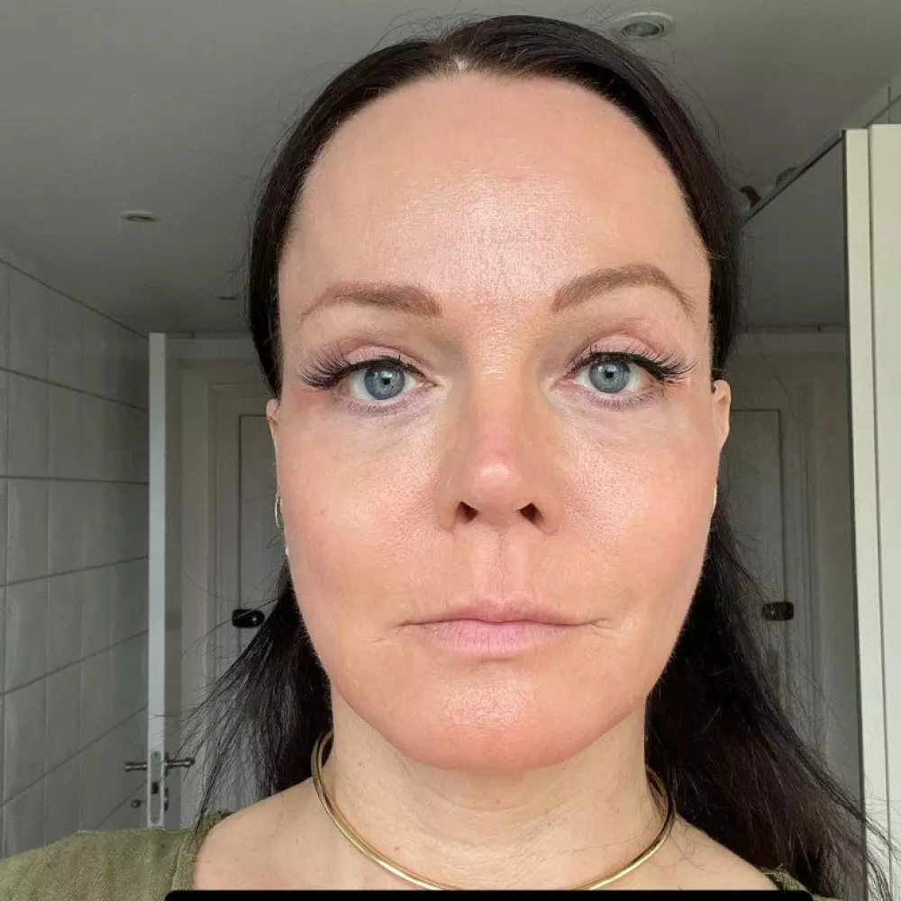 2 months after surgery