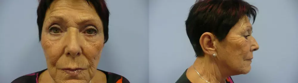 Před ošetřením frakčním laserem