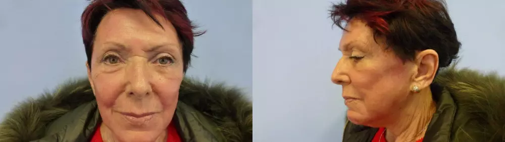 5 týdnů po ošetření frakčním laserem