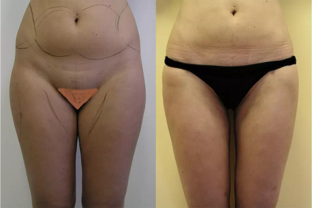 As layout before surgery are seen parts,where will do liposuction, after 3 months is good to see reduction of the fat, continuous lines of the hips and thighs are natural