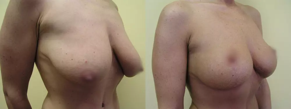 Menší povolené prsy po modelaci, je vidět vývoj jizvy i stabilizace tvaru prsů po 10 a 20 dnech po operaci a dále po 3 a 6 měsících.