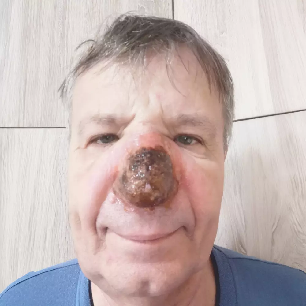 1. den po ošetření