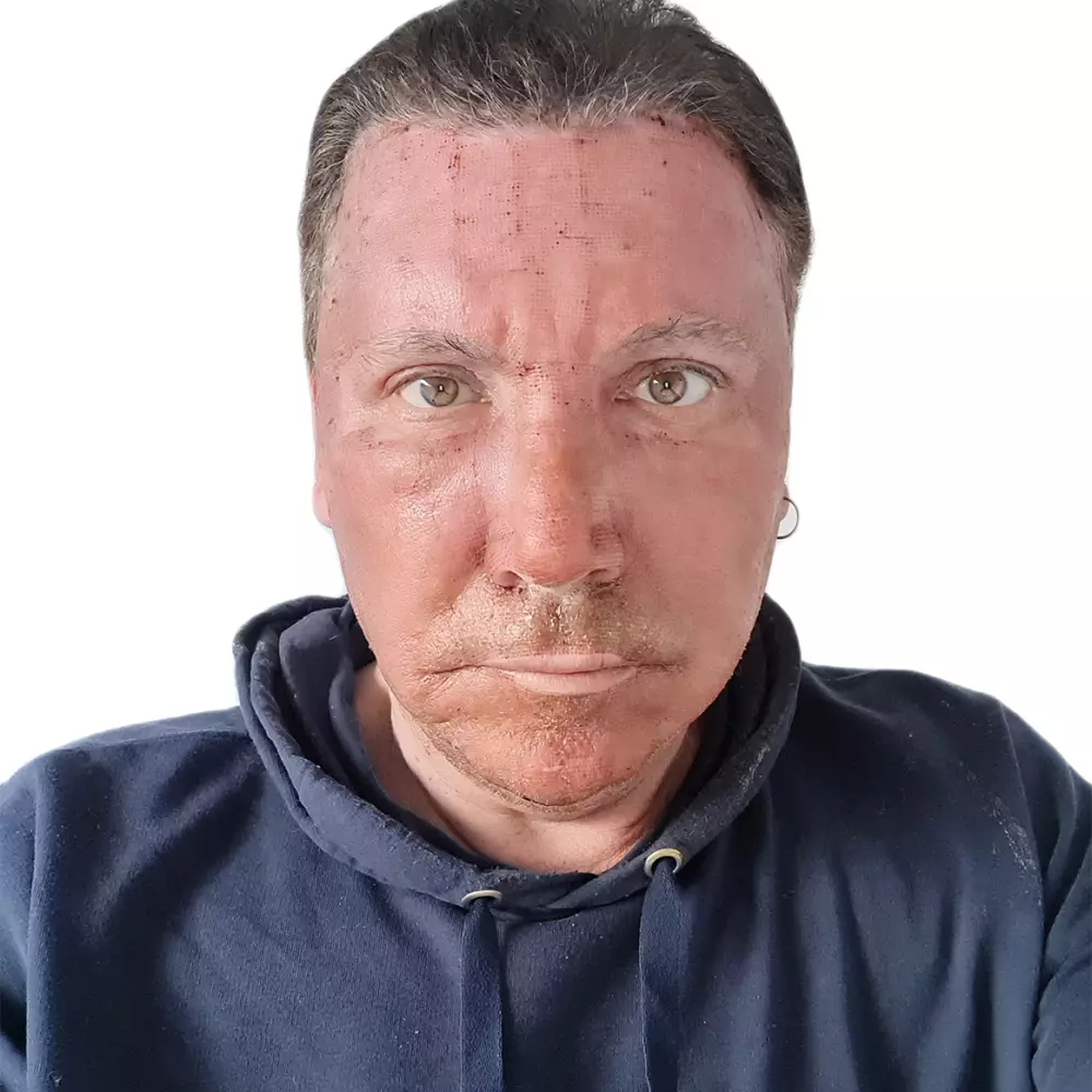 2 dny po ošetření