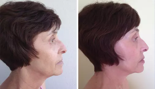 facelift před po fotky