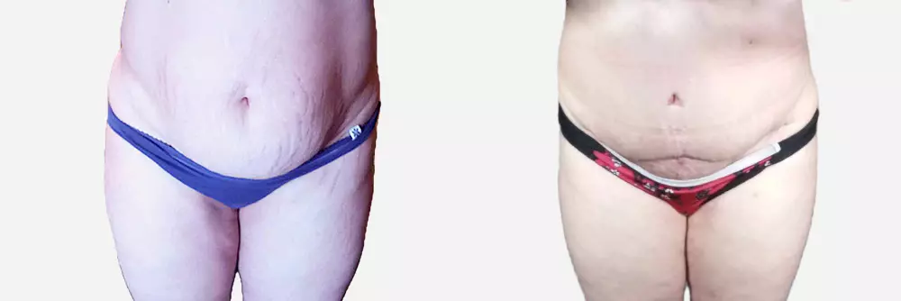 fotky před/po abdominoplastice