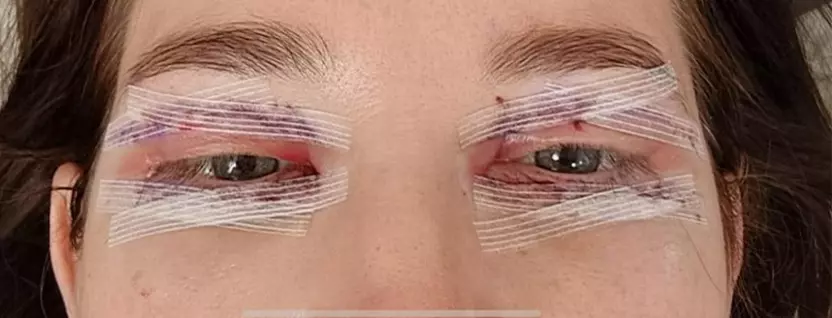 foto po operaci očních víček