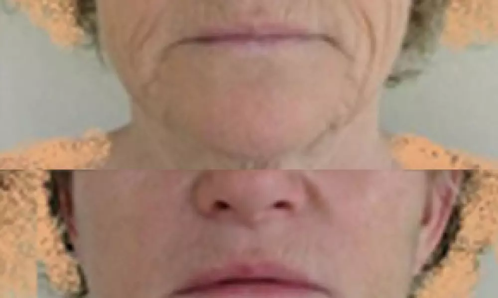 Facelift – lifting obličeje a krku