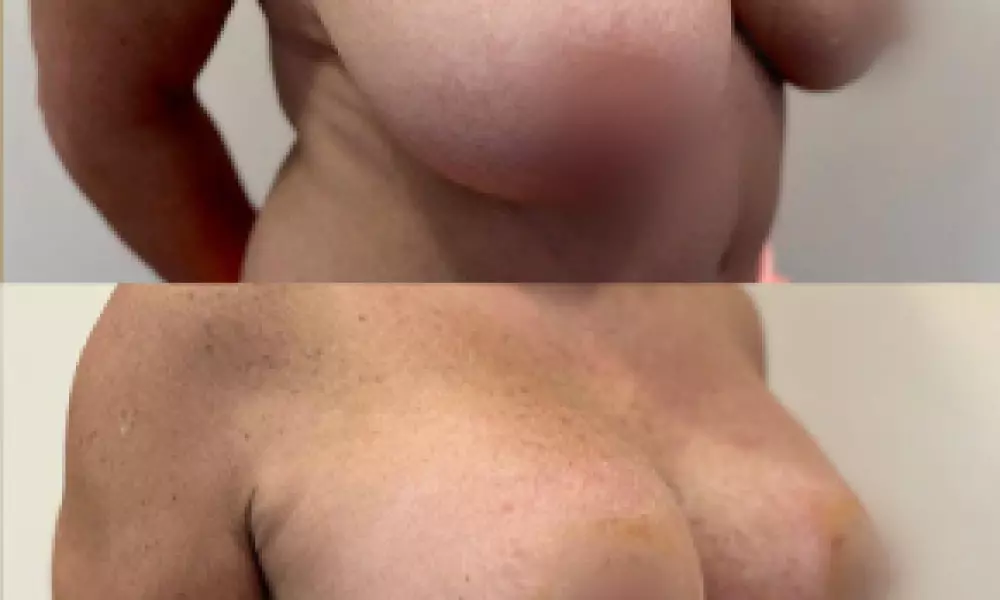 Modelace prsou – zpevnění