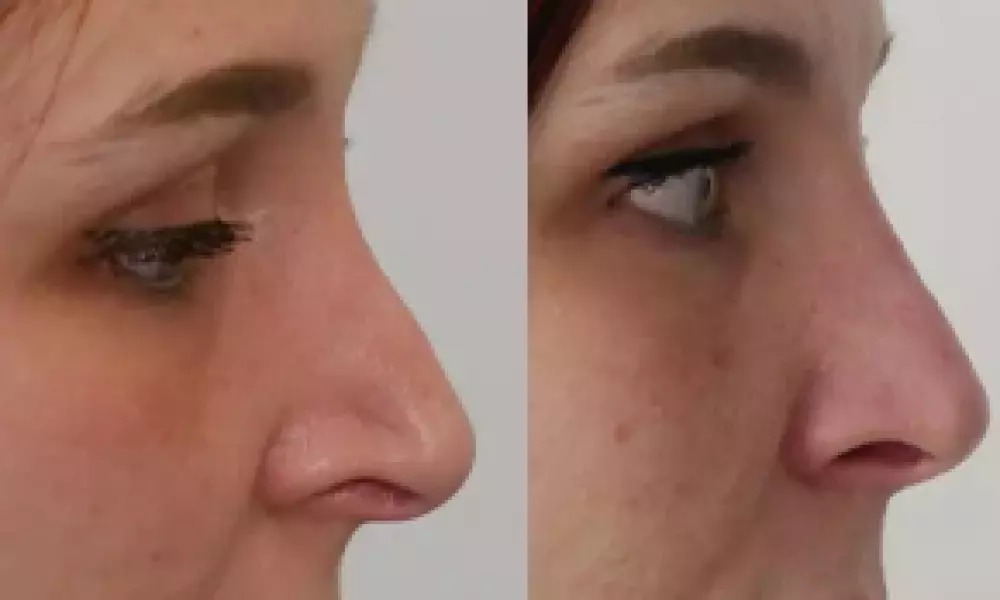 Plastika nosu (Rhinoplastika)
