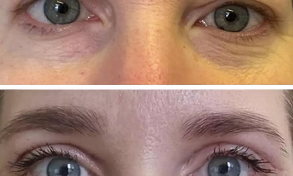 Operace očních víček (Blefaroplastika) 