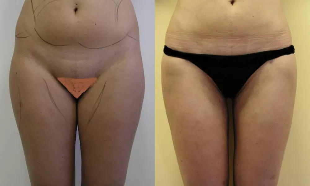 Liposukce – odsátí tuku