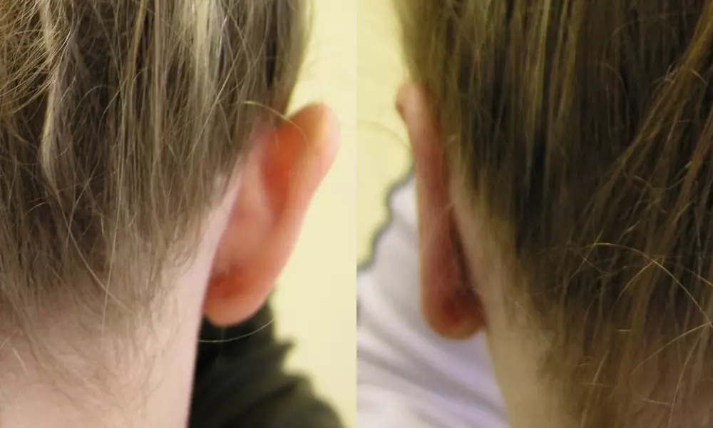 Plastika uší (Otoplastika)