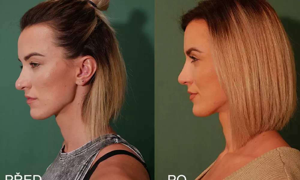 Plastika nosu na vlastní kůži