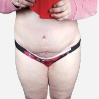 "Abdominoplastiku mám po těhotenství s dvojčaty"