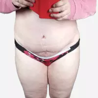 "Abdominoplastiku mám po těhotenství s dvojčaty"